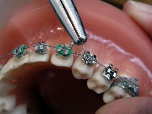 Alertan sobre los gravísimos riesgos de los “brakes” dentales piratas