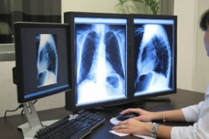 Científicos trazarán mapa genético del cáncer pulmonar
