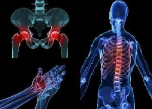 Osteoporosis: Cuando se pierde masa ósea, viene la fractura