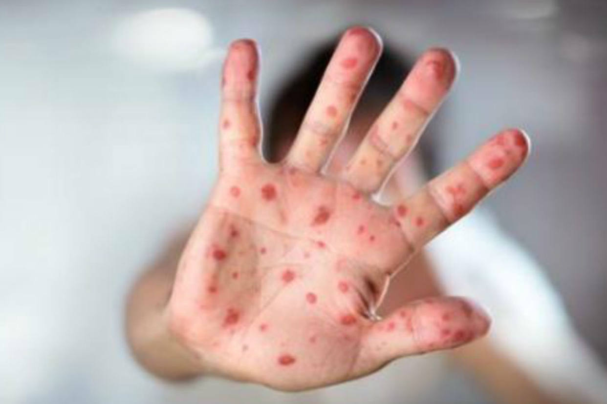 Niño que llegó de Venezuela es el primer caso de sarampión en Ecuador desde 2011
