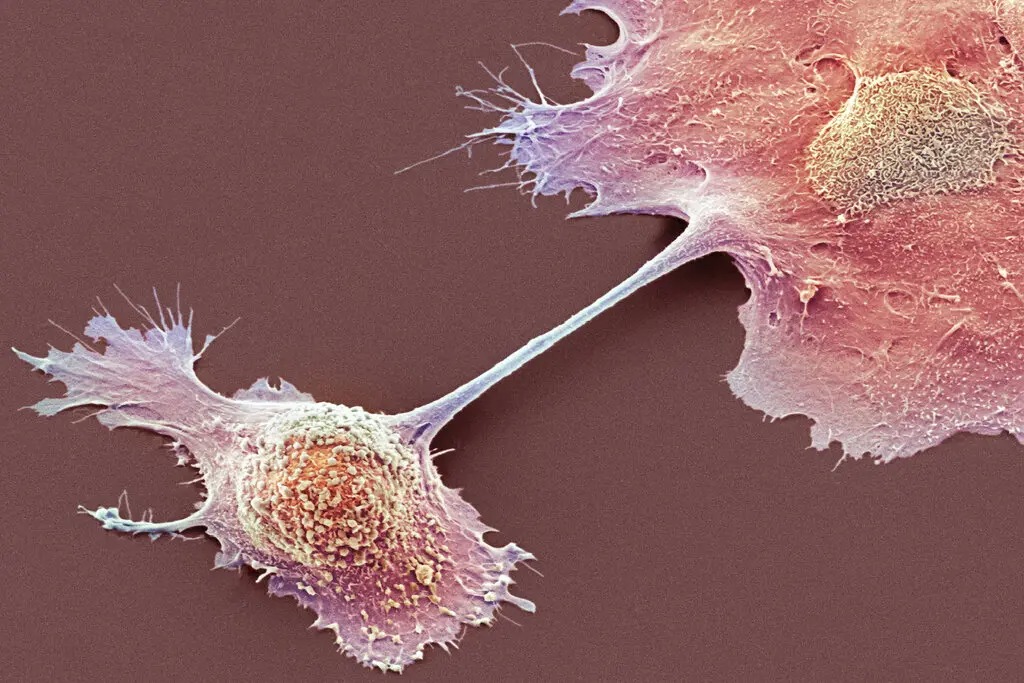 Células reprogramadas atacan y controlan el cáncer mortal en una mujer