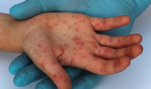 Panamá registra la primera muerte por viruela símica en el país