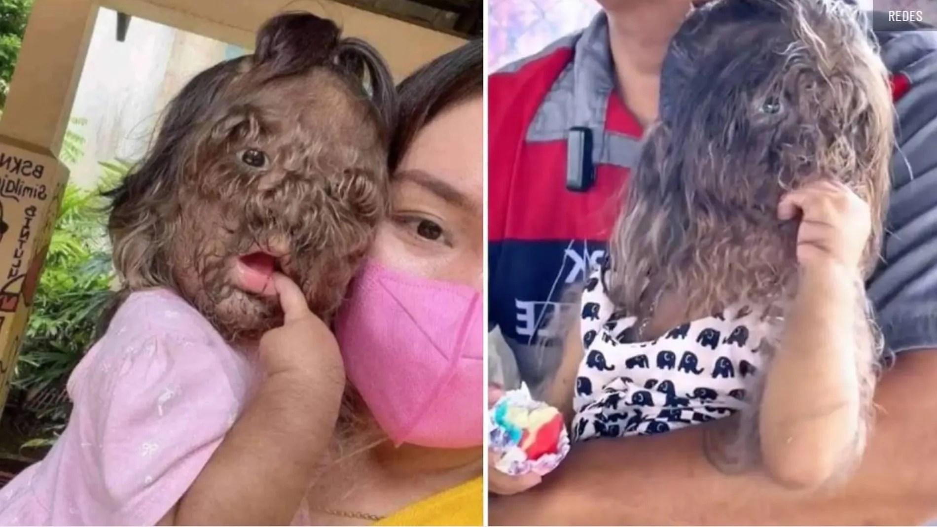 Adik Missclyen, la niña de dos años que se hizo viral por sufrir el “síndrome del hombre lobo”